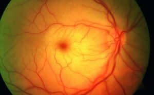 bva_retinaler arterienverschluss_feltgen_1