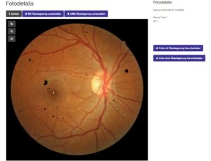eyebizz 5-2017: Augen-Screening - Netzhautlaesionen - Webanwendung RetinaLyze