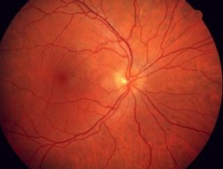 Augenärzte - Netzhautanalyse mittels KI