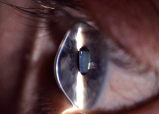 BVA - therapeutische Kontaktlinsen - beginnender Keratokonus