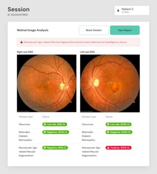 eyetelligence KI-Screening: Beispiel nAMD