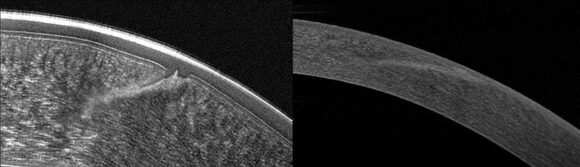 OCT Pentacam Cornea versus Standard c Oculus Optigeraete