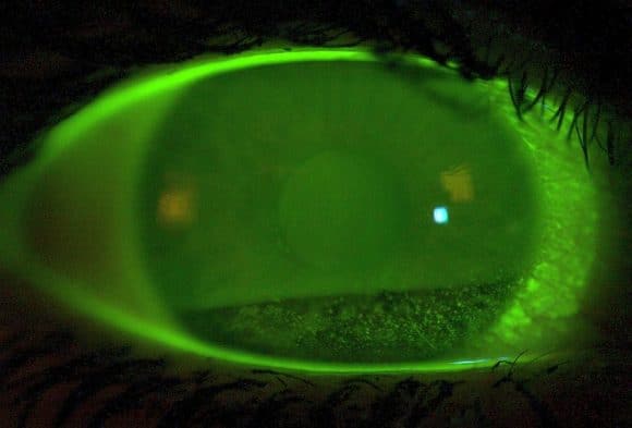 Kontaktlinsen Anpassung Lidschlag Stippung Grad 4 c Fetzer Schulungen