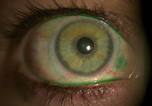 Kontaktlinsen Anpassung Randschlingennetz Lissamingrün-Ring c Fetzer Schulungen