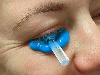 Formmasse Real-Shape-Kontaktlinsen-Geometrie c Wave Contact Lens System