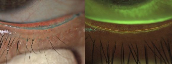 Tränenfilm Lidrand-Färbungen Lissamingrün und Fluorescein