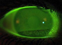 Tränenfilm Screening Lidschlag Fluorescein