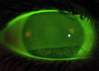 Tränenfilm Screening Lidschlag Fluorescein