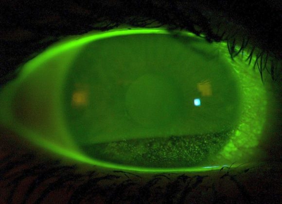 Tränenfilm Screening Lidschlag Fluorescein
